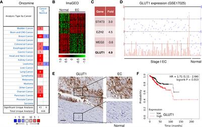 Long Non-Coding RNA TMPO-AS1 Promotes GLUT1-Mediated Glycolysis and Paclitaxel Resistance in Endometrial Cancer Cells by Interacting With miR-140 and miR-143